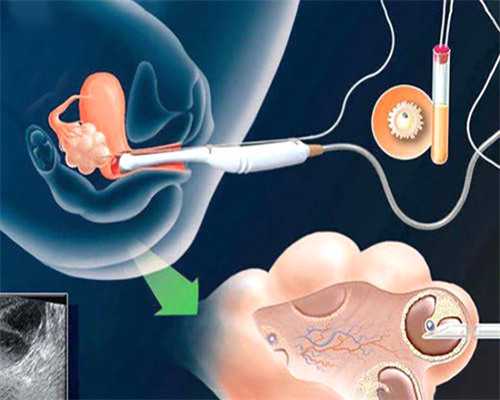 卵泡监测怎么测最准确怎么看结果,靠谱代怀